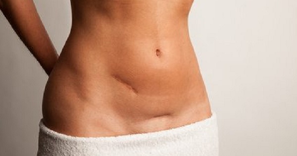 TUMMY TUCKS SCARS TREATMENT: - Pharmaclinix